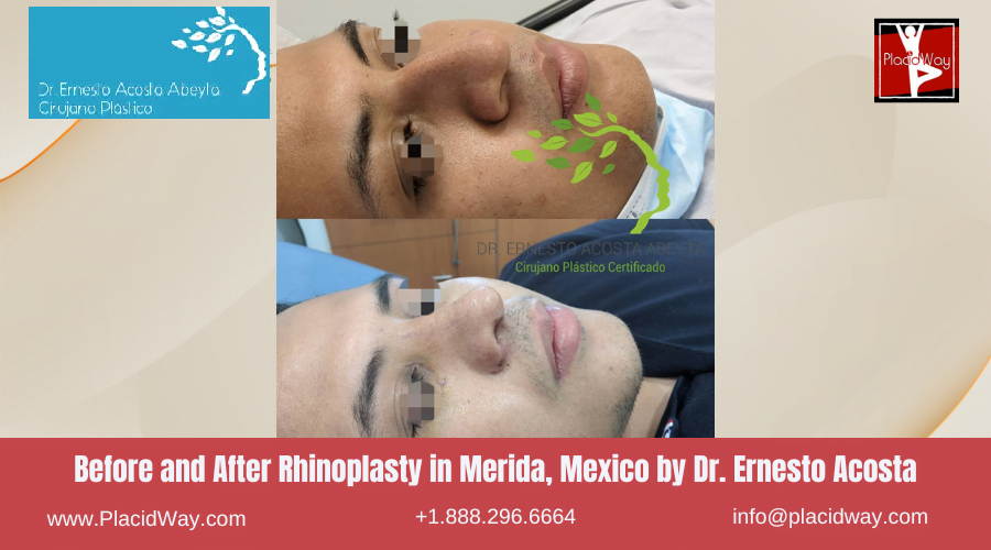 Rhinoplasty in Merida Mexico by Medina Flores