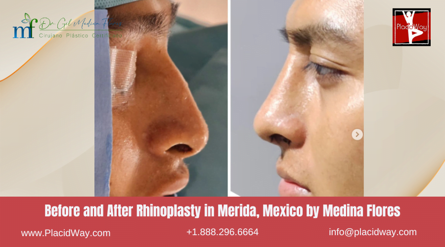 Rhinoplasty in Merida Mexico by Medina Flores