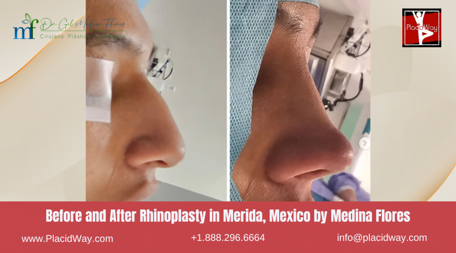 Rhinoplasty in Merida Mexico by Medina Flores