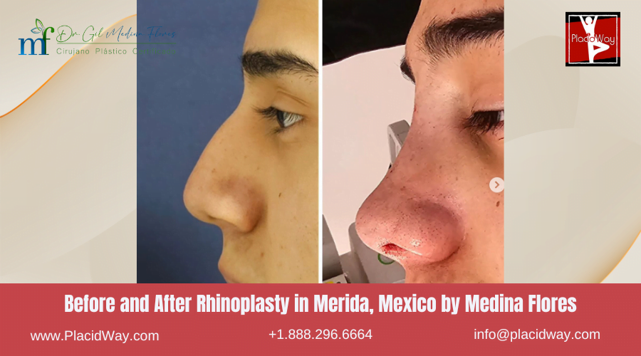 Rhinoplasty in Merida Mexico by Medina Flores