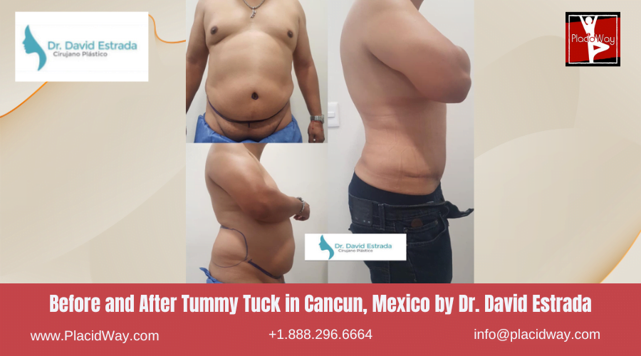 Tummy Tuck in Cancun, Mexico Dr. David Estrada