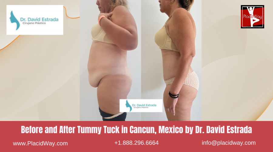 Tummy Tuck in Cancun, Mexico Dr. David Estrada