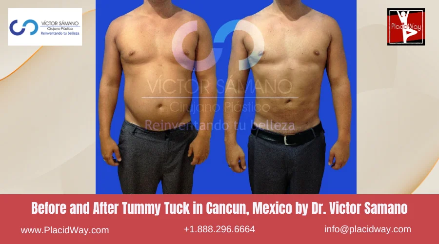 Tummy Tuck in Cancun, Mexico Dr. Victor Samano