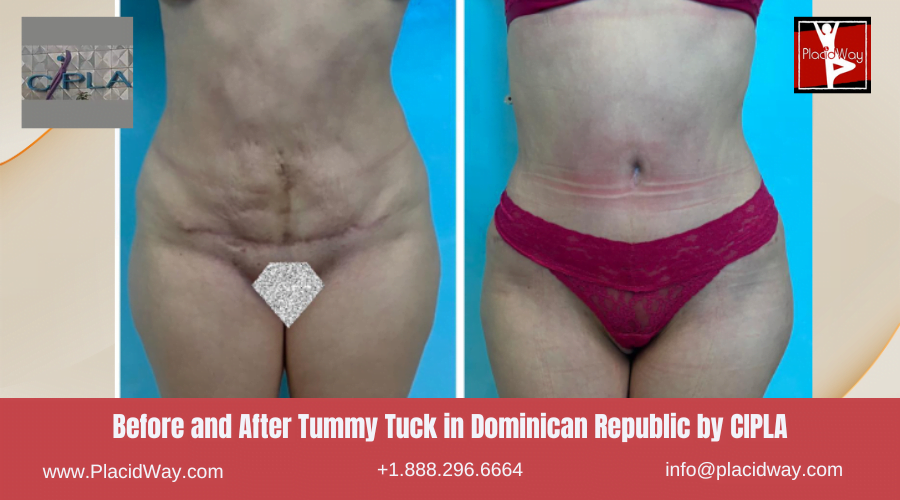 Tummy Tuck in Dominican Republic Before and After Images
