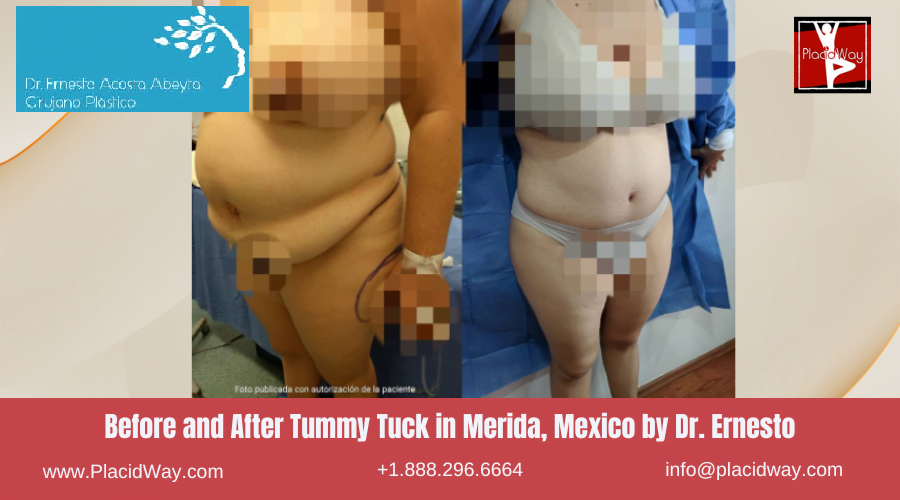 Before and After Images for Tummy Tuck Surgery in Merida, Mexico