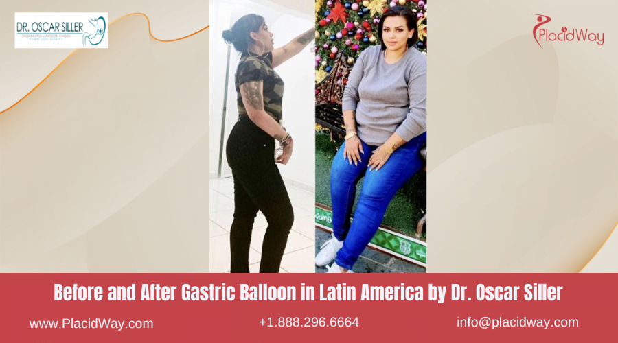 Gastric Balloon in Latin America Before and After Images - Oscar Siller