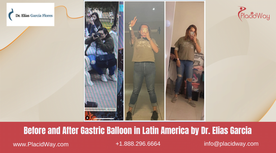 Gastric Balloon in Latin America Before and After Images - Elias Garcia