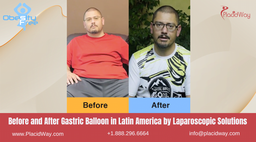 Gastric Balloon in Latin America Before and After Images - Laparoscopic Solutions