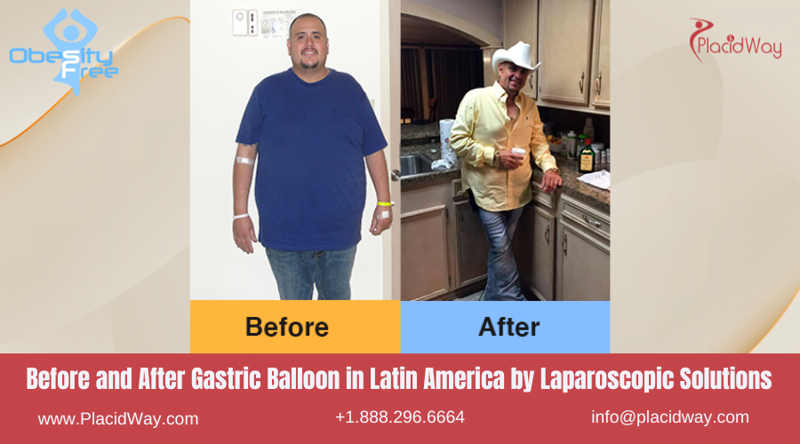 Gastric Balloon in Latin America Before and After Images - Laparoscopic Solutions