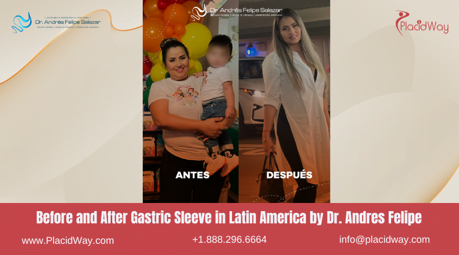 Gastric Sleeve in Latin America Before and After Images - Dr Andres Felipe