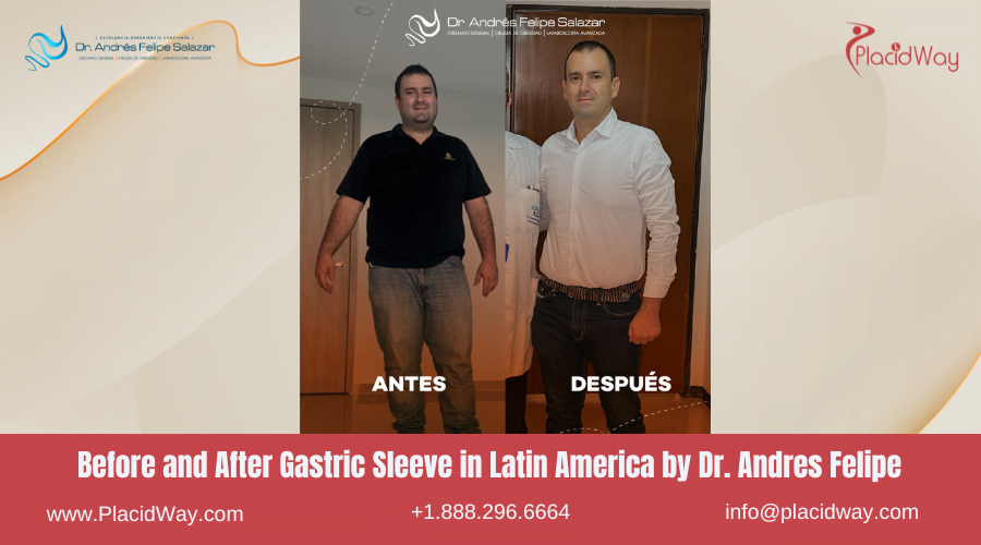 Gastric Sleeve in Latin America Before and After Images - Dr Andres Felipe