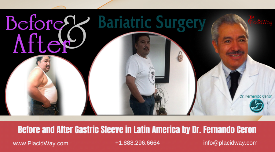 Gastric Sleeve in Latin America Before and After Images - Dr Fernando Ceron