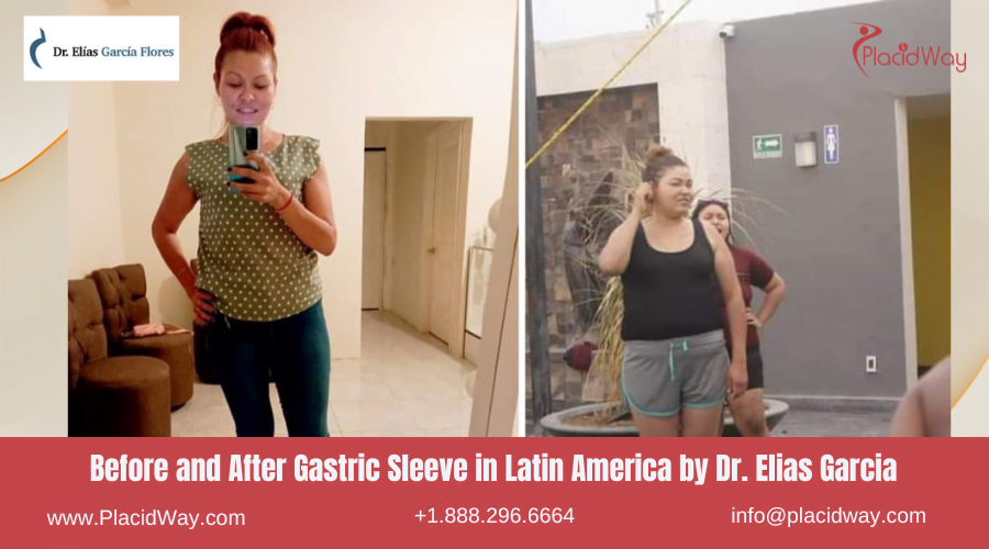 Gastric Sleeve in Latin America Before and After Images - Dr Elias Garcia