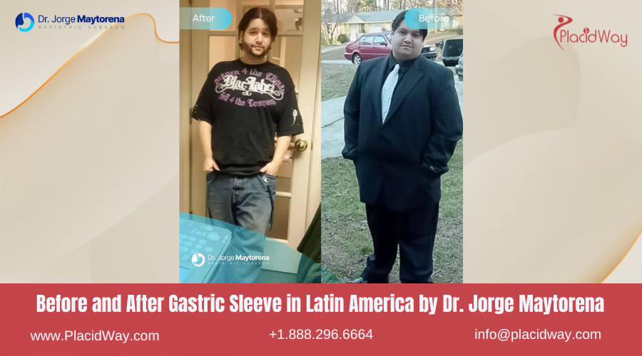 Gastric Sleeve in Latin America Before and After Images - Dr Jorge Maytorena