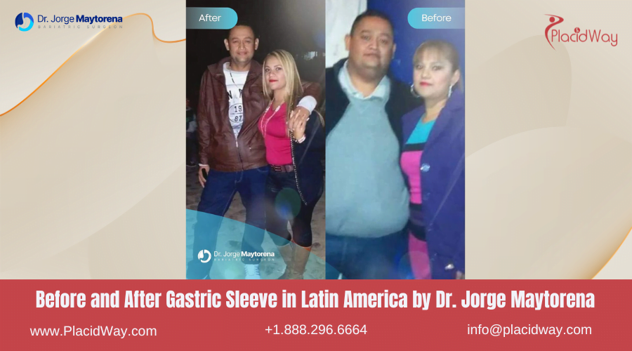 Gastric Sleeve in Latin America Before and After Images - Dr Jorge Maytorena