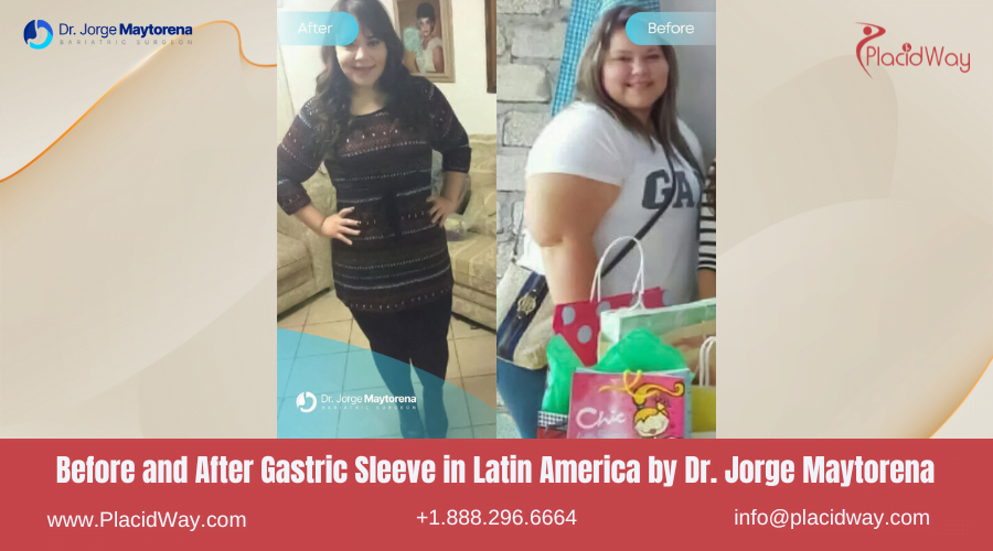 Gastric Sleeve in Latin America Before and After Images - Dr Jorge Maytorena