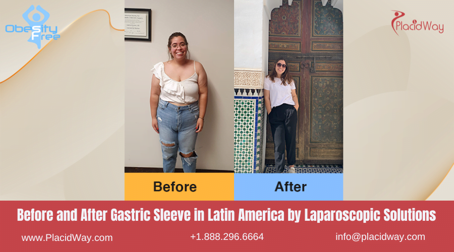 Gastric Sleeve in Latin America Before and After Images - Laparoscopic Solutions