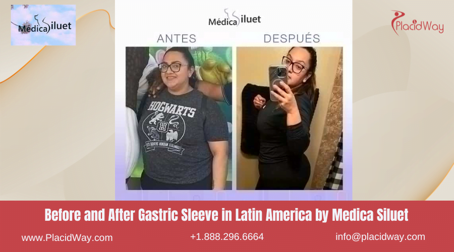 Gastric Sleeve in Latin America Before and After Images - Medica Siluet