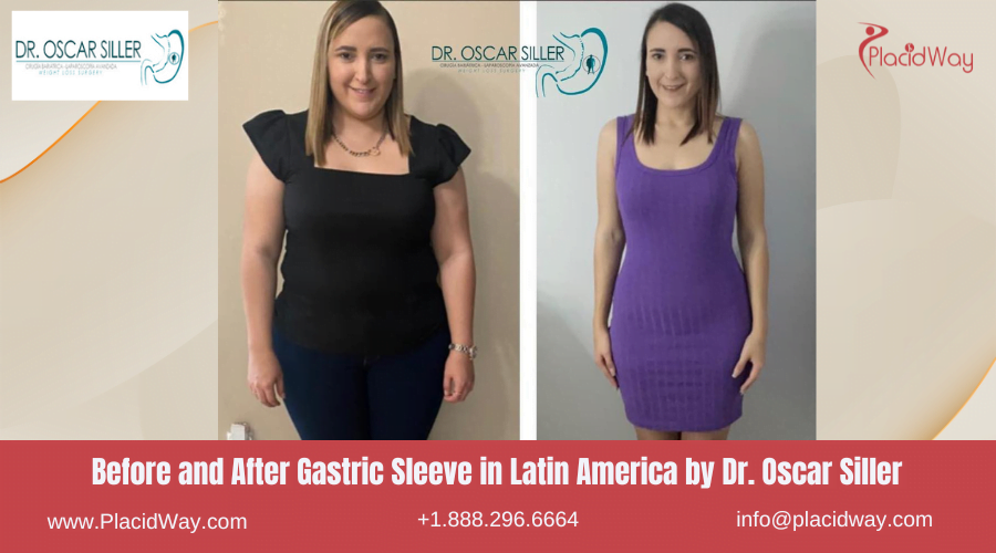 Gastric Sleeve in Latin America Before and After Images - Oscar Siller