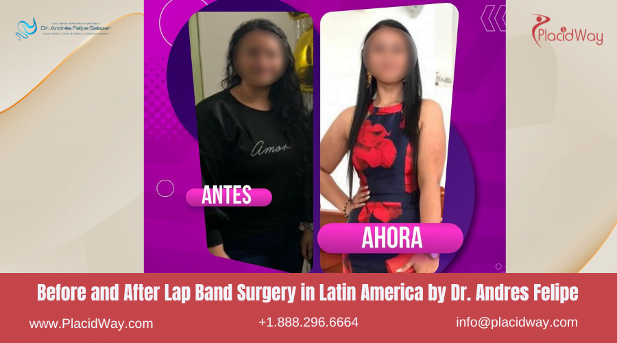 Lap Band Surgery in Larin America Before and After Images - Andres Felipe