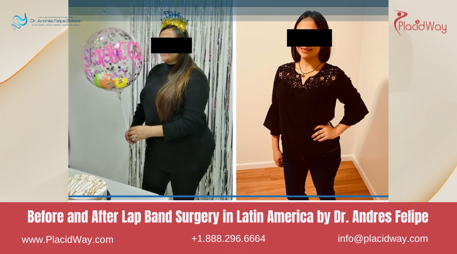 Lap Band Surgery in Larin America Before and After Images - Andres Felipe