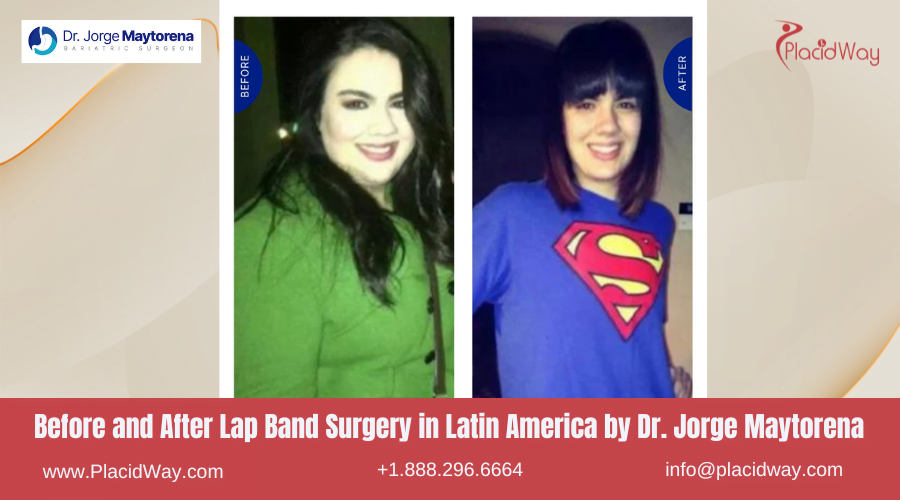 Lap Band Surgery in Larin America Before and After Images - Jorge Maytorena