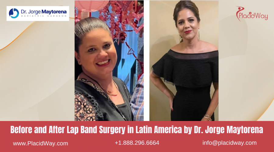 Lap Band Surgery in Larin America Before and After Images - Jorge Maytorena