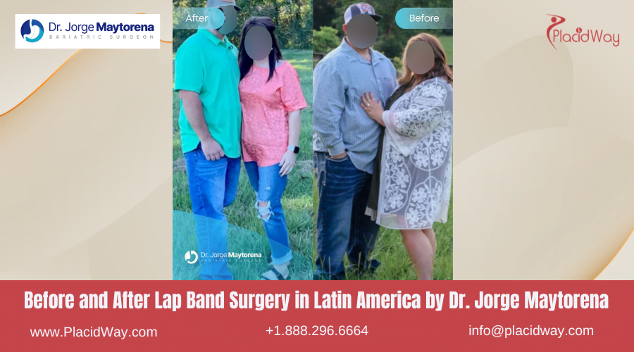 Lap Band Surgery in Larin America Before and After Images - Jorge Maytorena