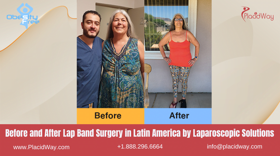 Lap Band Surgery in Larin America Before and After Images - Laparoscopic Solutions