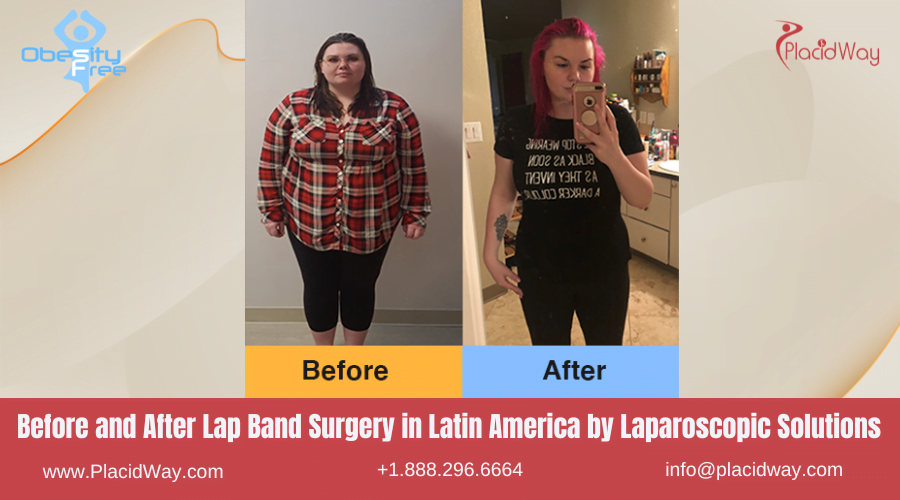 Lap Band Surgery in Larin America Before and After Images - Laparoscopic Solutions