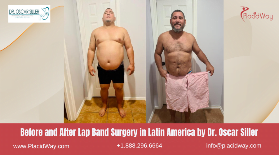 Lap Band Surgery in Larin America Before and After Images - Oscar Siller