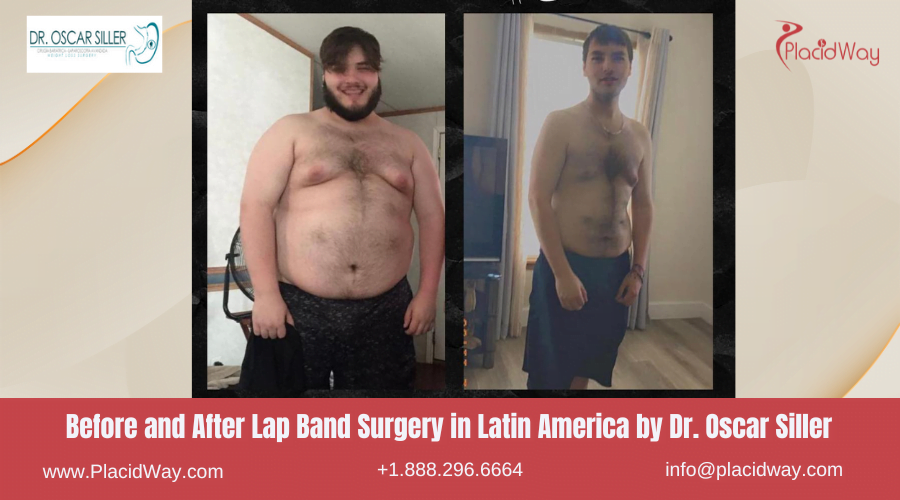 Lap Band Surgery in Larin America Before and After Images - Oscar Siller