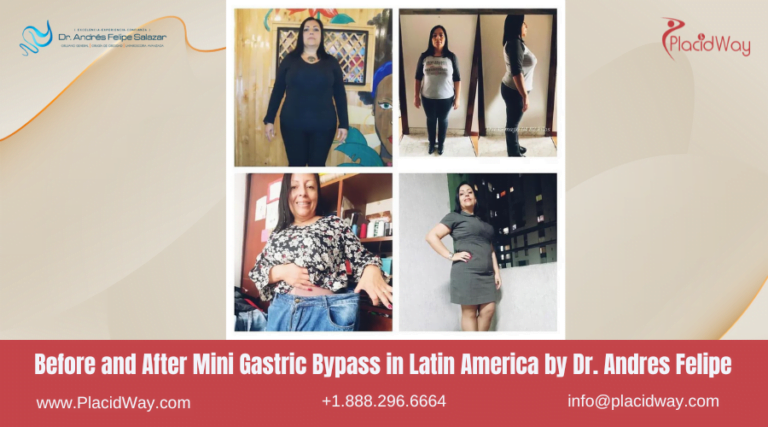 Best Surgeons for Mini Gastric Bypass in Latin America