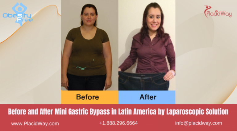 Best Surgeons for Mini Gastric Bypass in Latin America