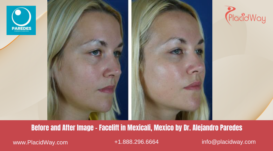 Facelift in Mexicali Mexico