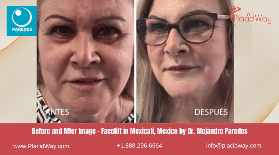 Facelift in Mexicali Mexico