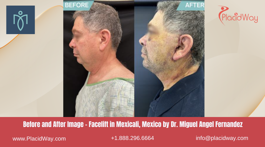 Facelift in Mexicali Mexico