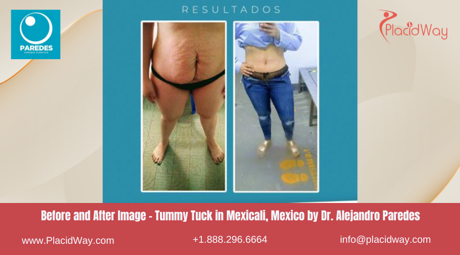 Tummy Tuck in Mexicali Mexico