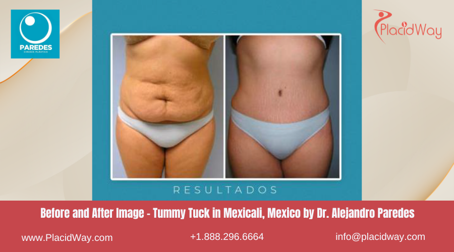 Tummy Tuck in Mexicali Mexico