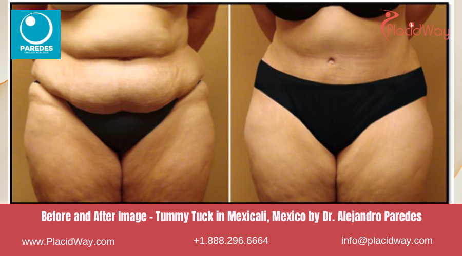 Tummy Tuck in Mexicali Mexico