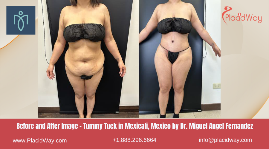 Tummy Tuck in Mexicali Mexico