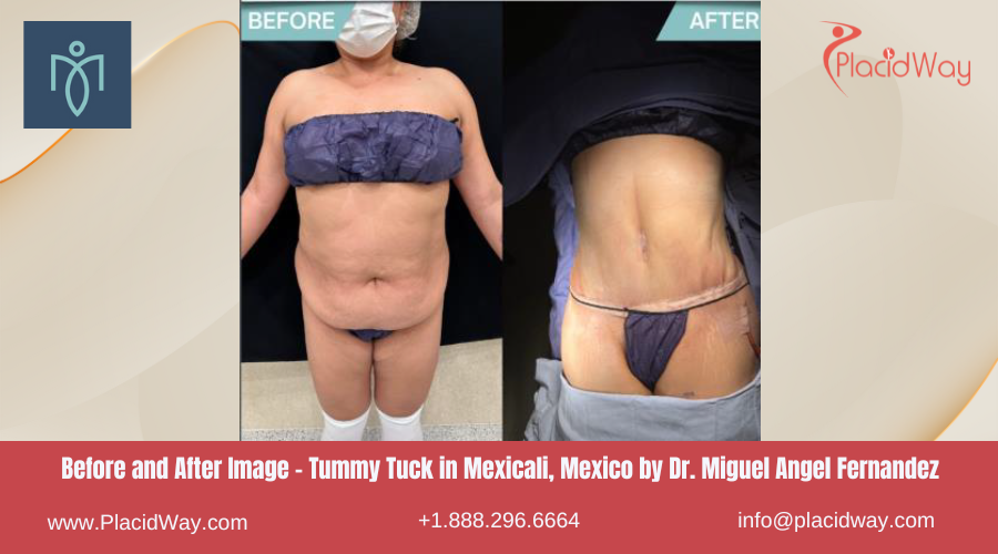 Tummy Tuck in Mexicali Mexico