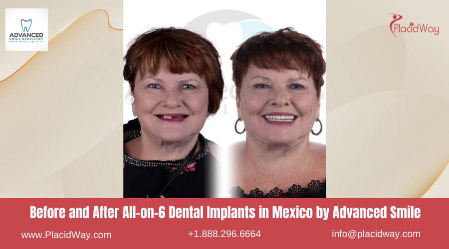 All on 6 Dental Implants in Mexico Before and After Image by Advanced Smile Dentistry