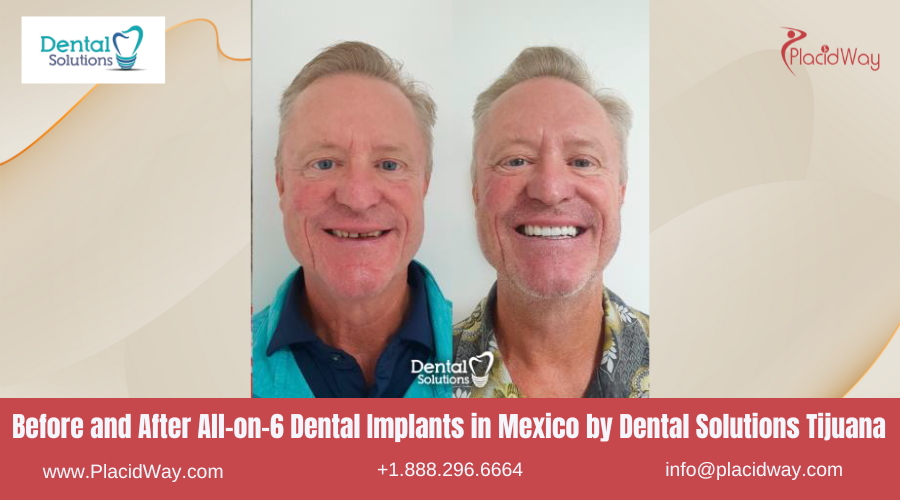 All on 6 Dental Implants in Mexico Before and After Image by Dental Solutions