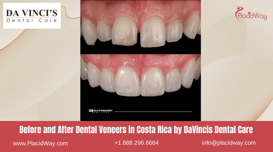 Before and After Images for Dental Veneers in Costa Rica DaVincis 2