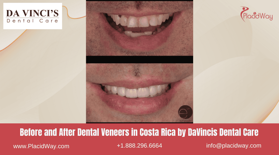 Before and After Images for Dental Veneers in Costa Rica DaVincis