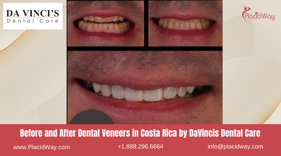 Before and After Images for Dental Veneers by DaVincis Clinic in Costa Rica 