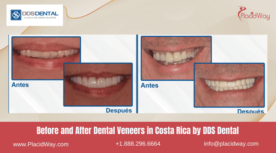 Before and After Images for Dental Veneers in Costa Rica by DDS Dental