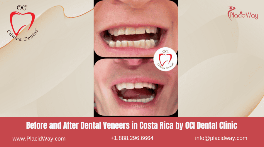 Affordable Dental Veneers in Costa Rica