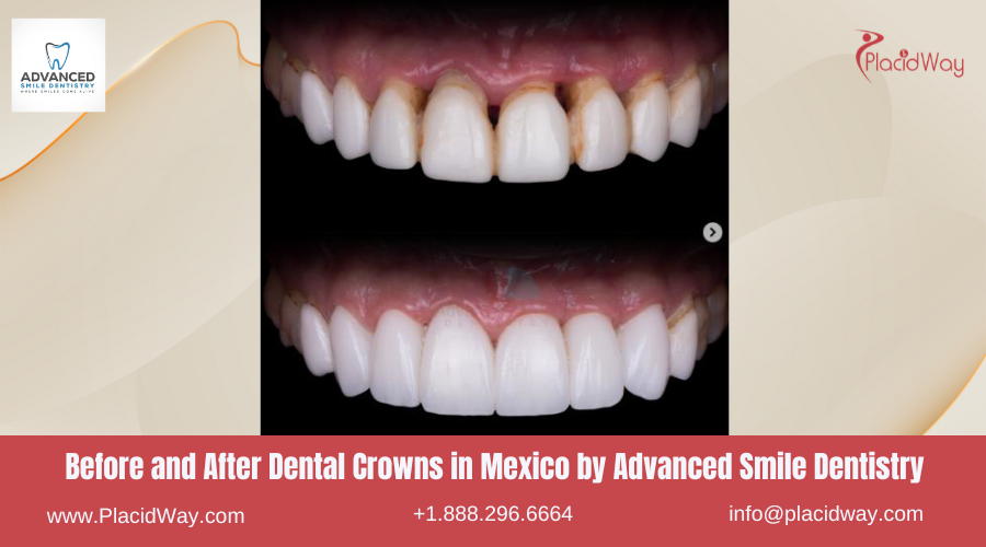 Dental Crowns in Mexico Before and After Image by Advanced Smile Dentistry